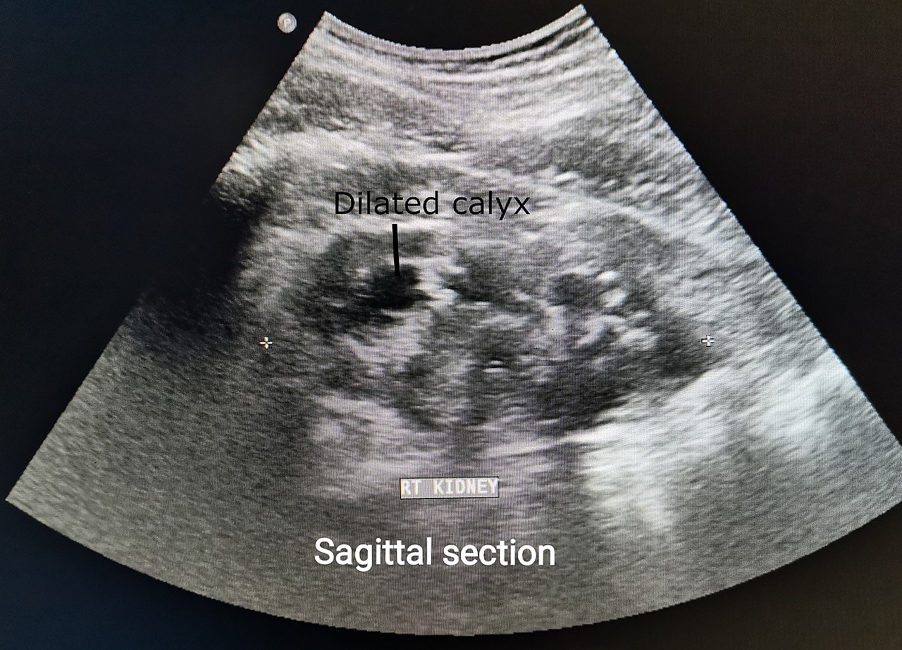 renal ultrasound scan