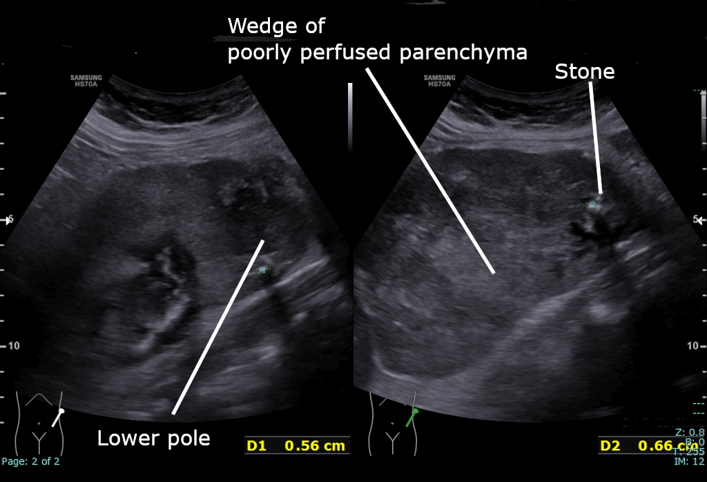 renal ultrasound scan