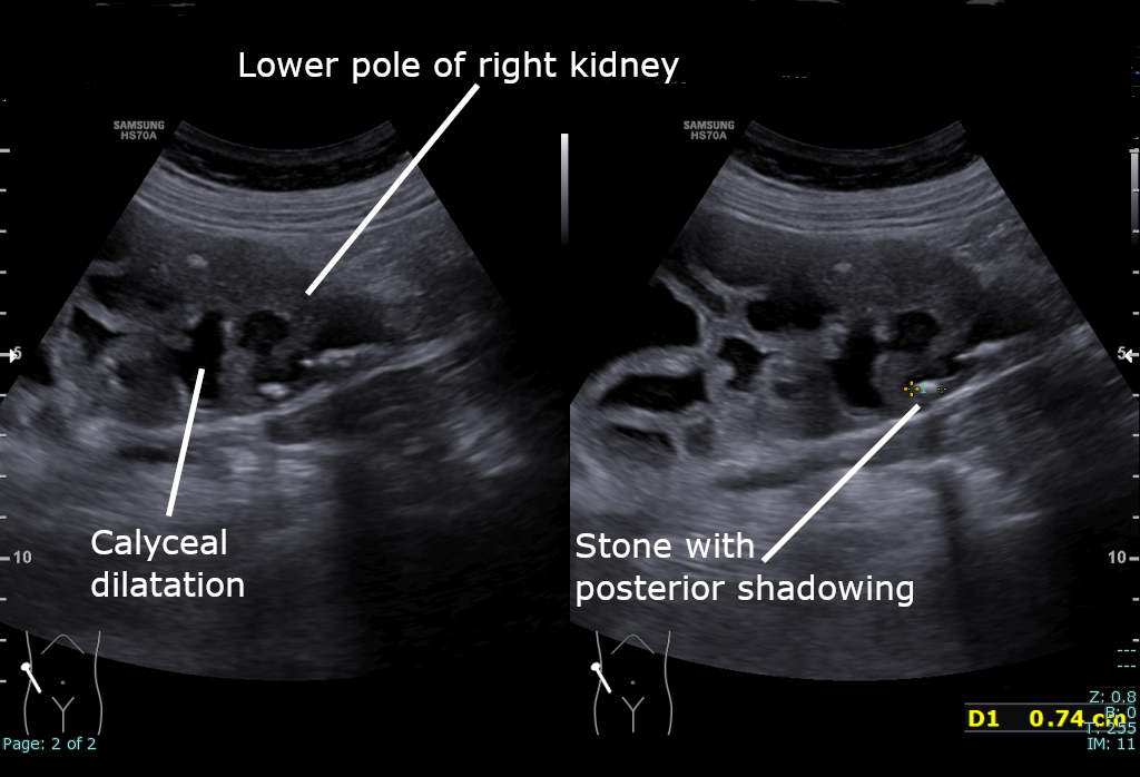 renal ultrasound scan