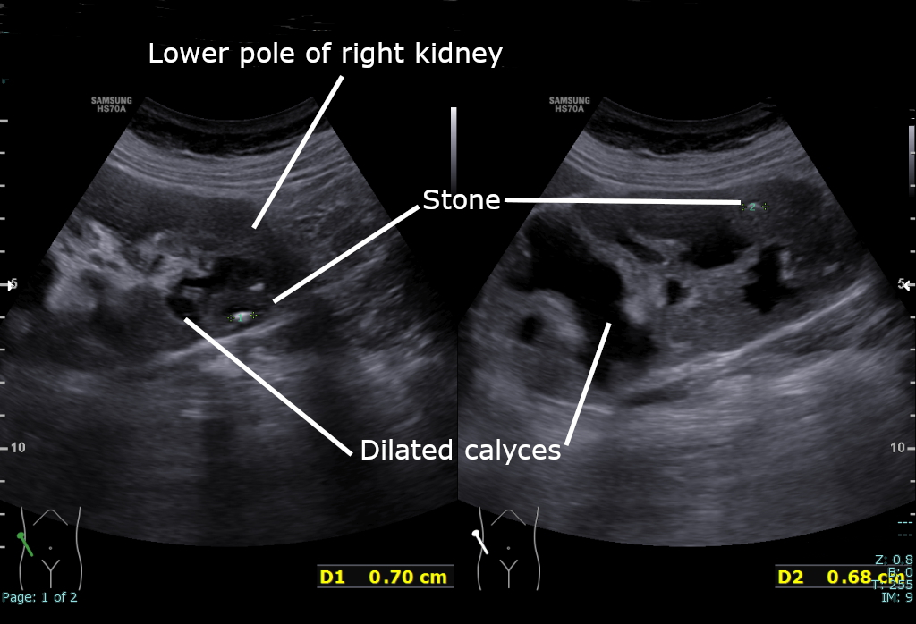 renal ultrasound scan