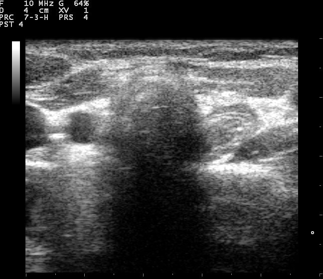 thyroid ultrasound scan