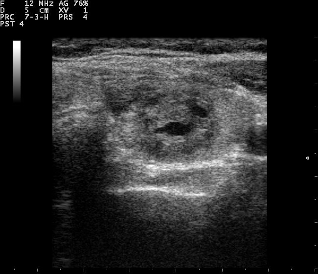 thyroid ultrasound scan