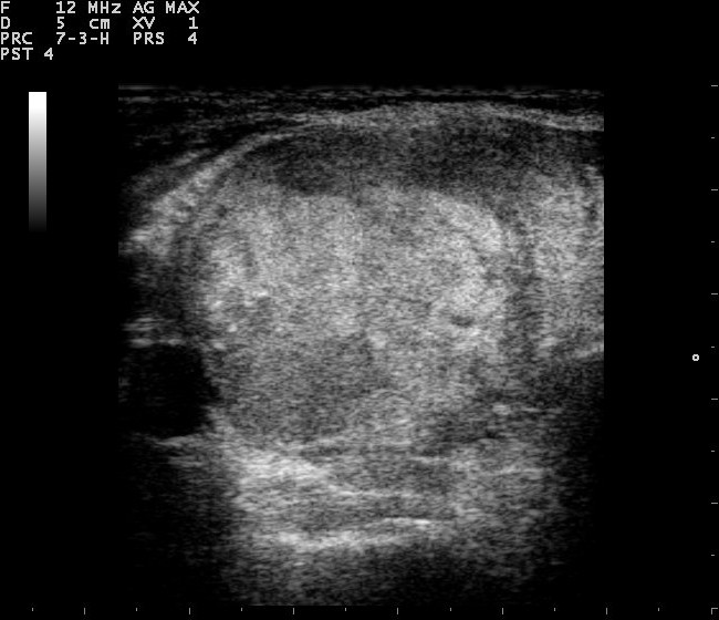 thyroid ultrasound scan