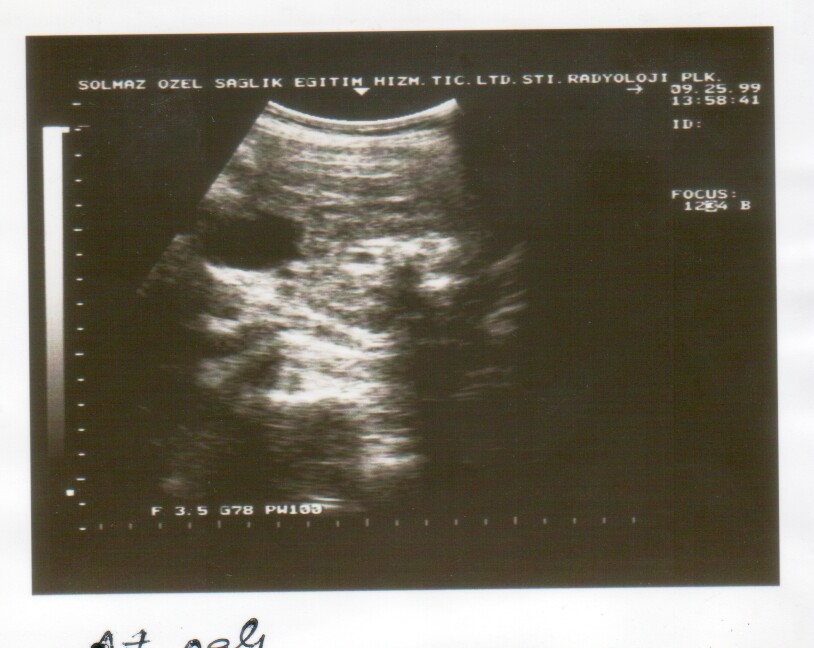 ultrasound scan image