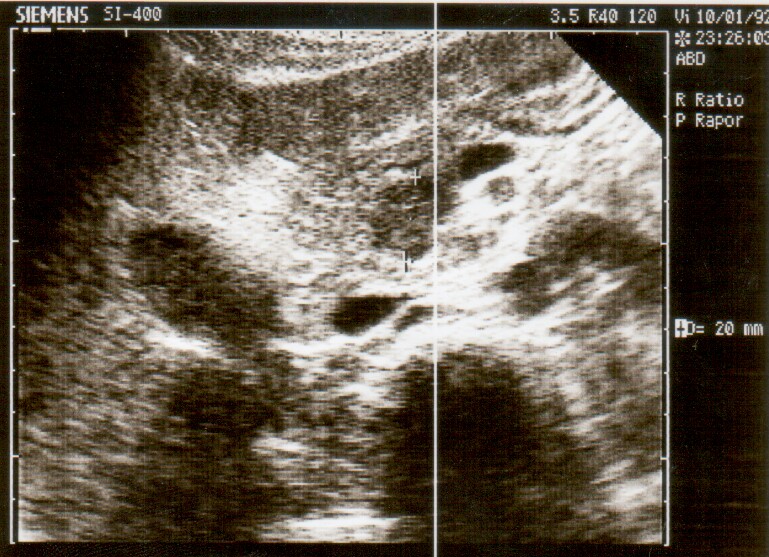 ultrasound scan image