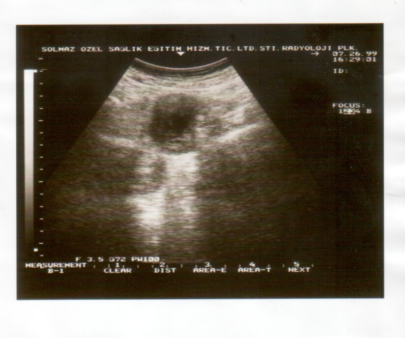 ultrasound scan image