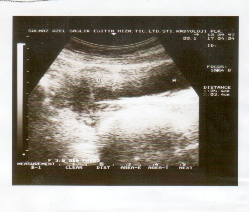 ultrasound scan image