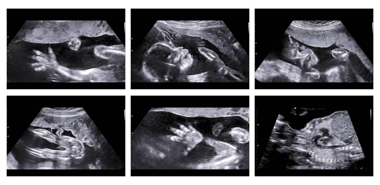 fetal ultrasound scan