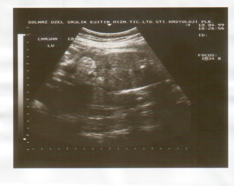 ultrasound scan image