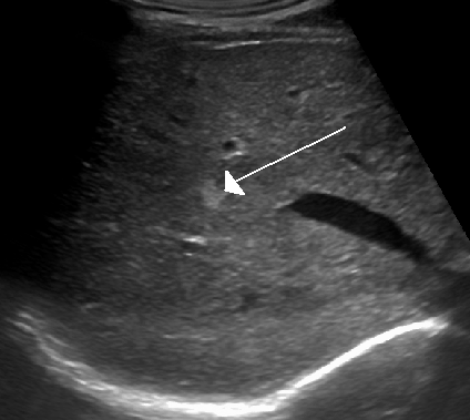 Ultrasound image of a hepatic hemangioma showing a well-defined hyperechoic lesion in the liver