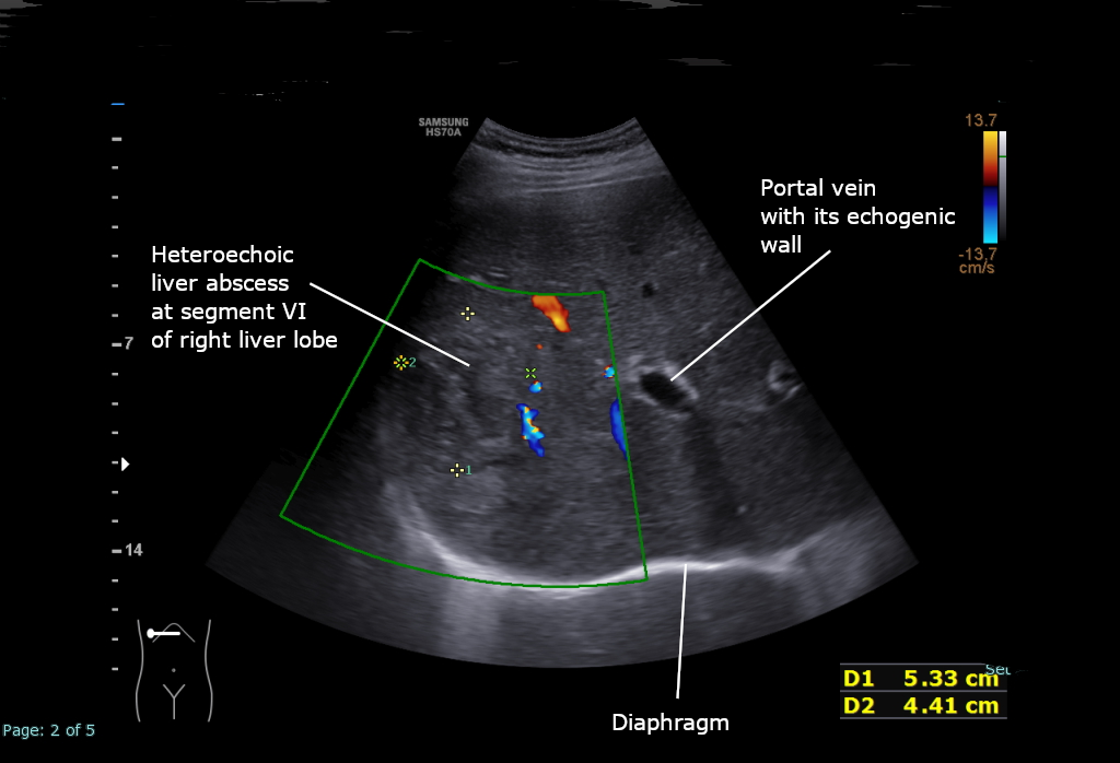 Ultrasound image showing a loculated liver abscess in segment VI of the liver