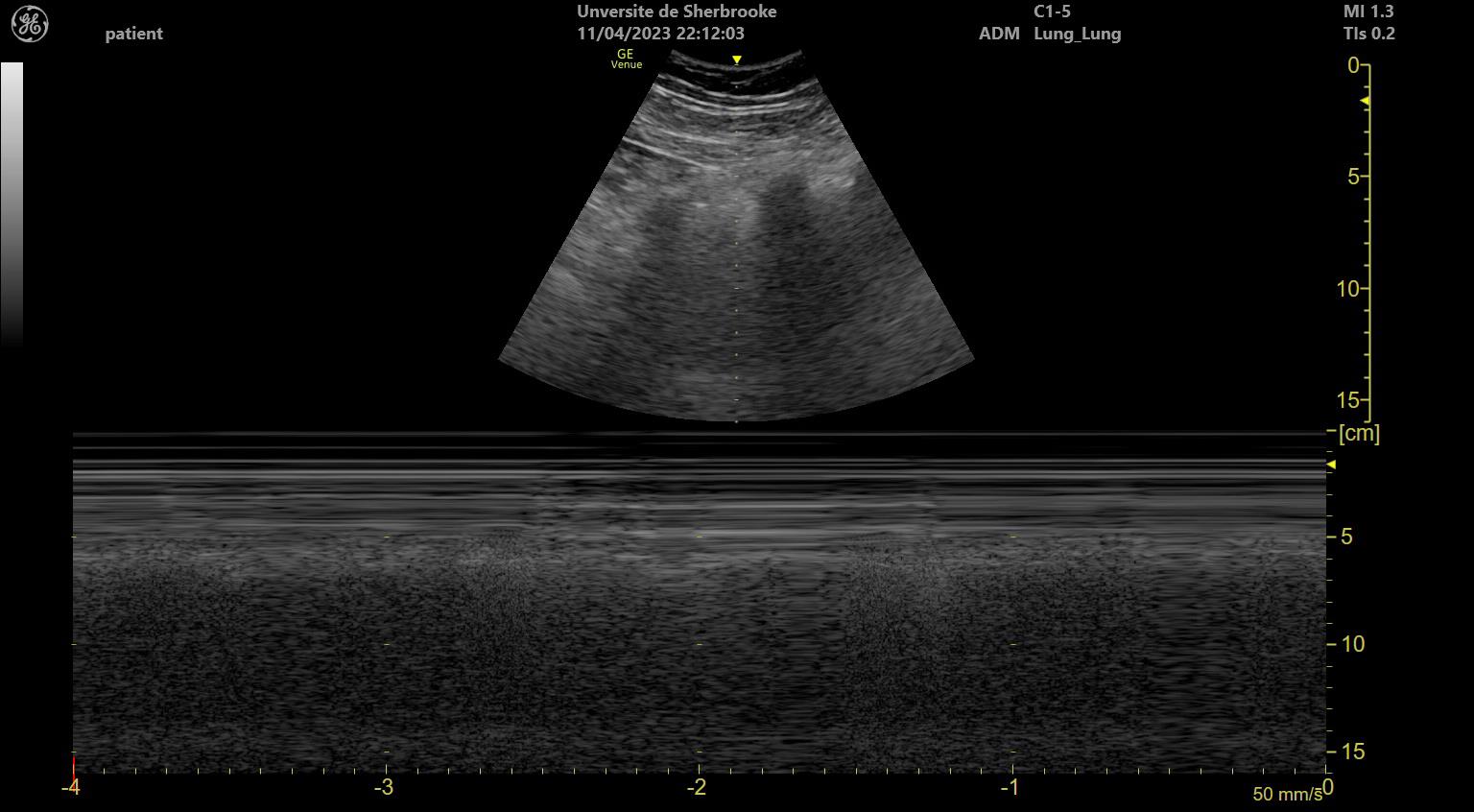 M-mode lung ultrasound seashore sign