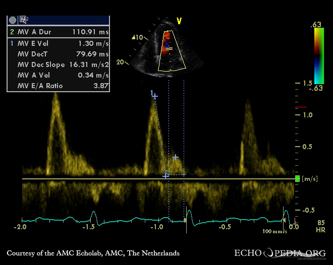 Spectral Doppler trace of mitral inflow
