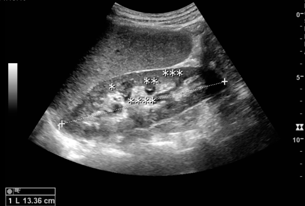 Longitudinal ultrasound of a normal kidney, the flank station of the abdominal scan sequence