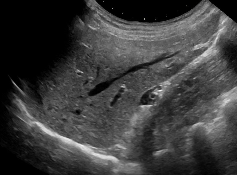 Convex-probe abdominal ultrasound of a normal liver