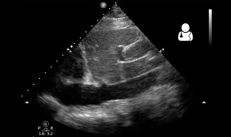 Subxiphoid echocardiogram showing a pericardial effusion around the heart
