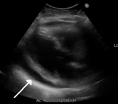 Bedside ultrasound of fluid around the heart