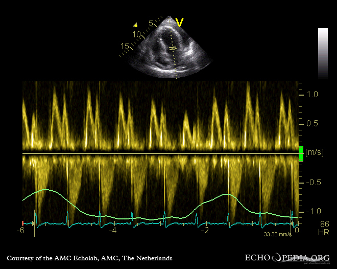Mitral inflow Doppler showing respiratory variation in tamponade