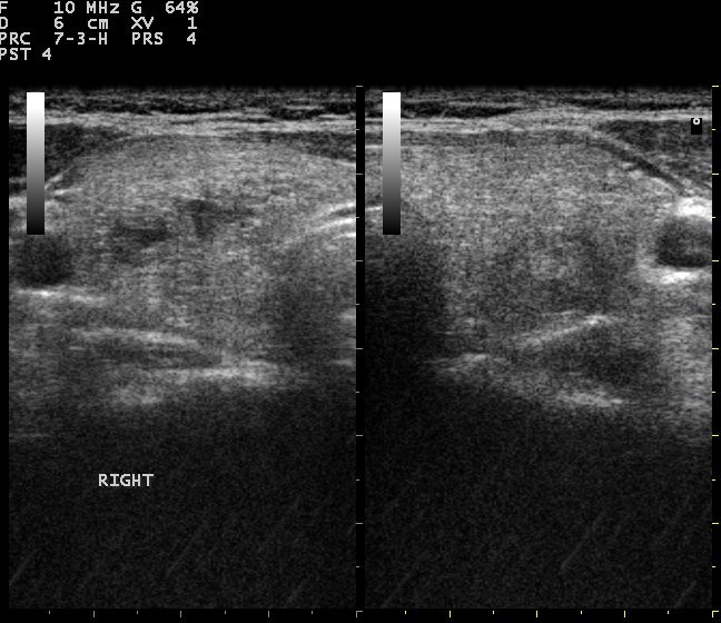 A grayscale ultrasound image produced by a handheld probe