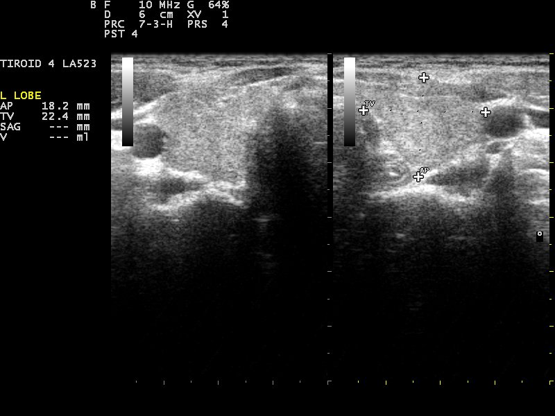 An ultrasound scan of soft tissue on a handheld device