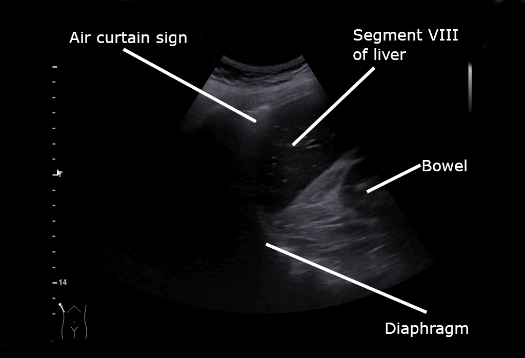 Normal lung ultrasound, pleural line and A-lines