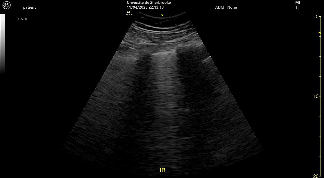 B-lines on lung ultrasound