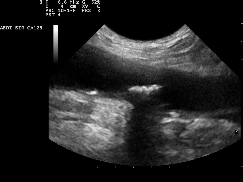 An abdominal aorta ultrasound view