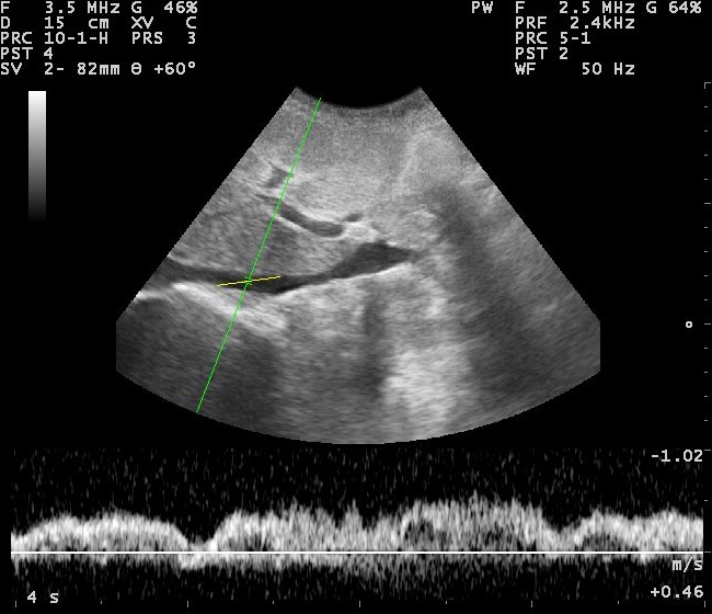 An ultrasound of the inferior vena cava, the tank gauge