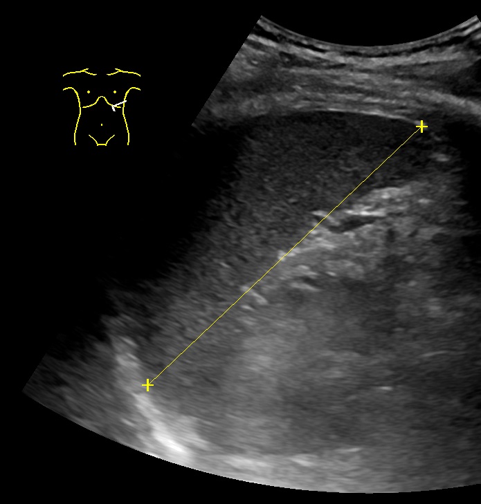 Ultrasound image showing the maximum craniocaudal length of the spleen measured from diaphragmatic dome to inferior tip