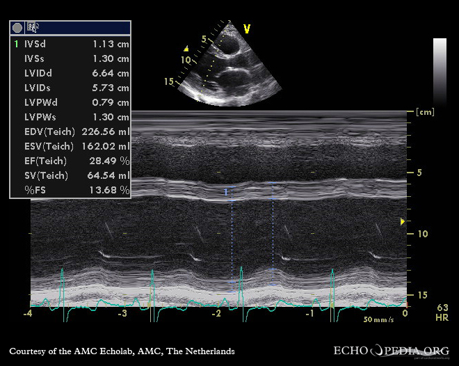 Spontaneous echo contrast on echocardiography