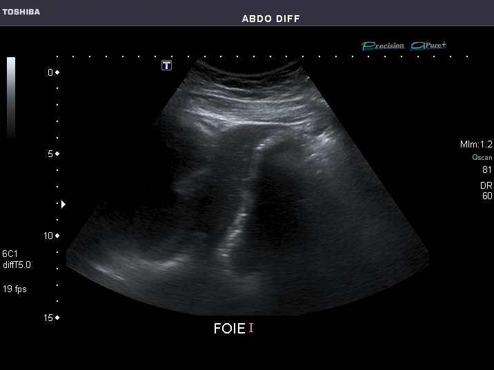 An abdominal ultrasound view of the organs and the spaces between them