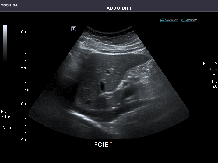 A focused abdominal ultrasound, the kind read for free fluid