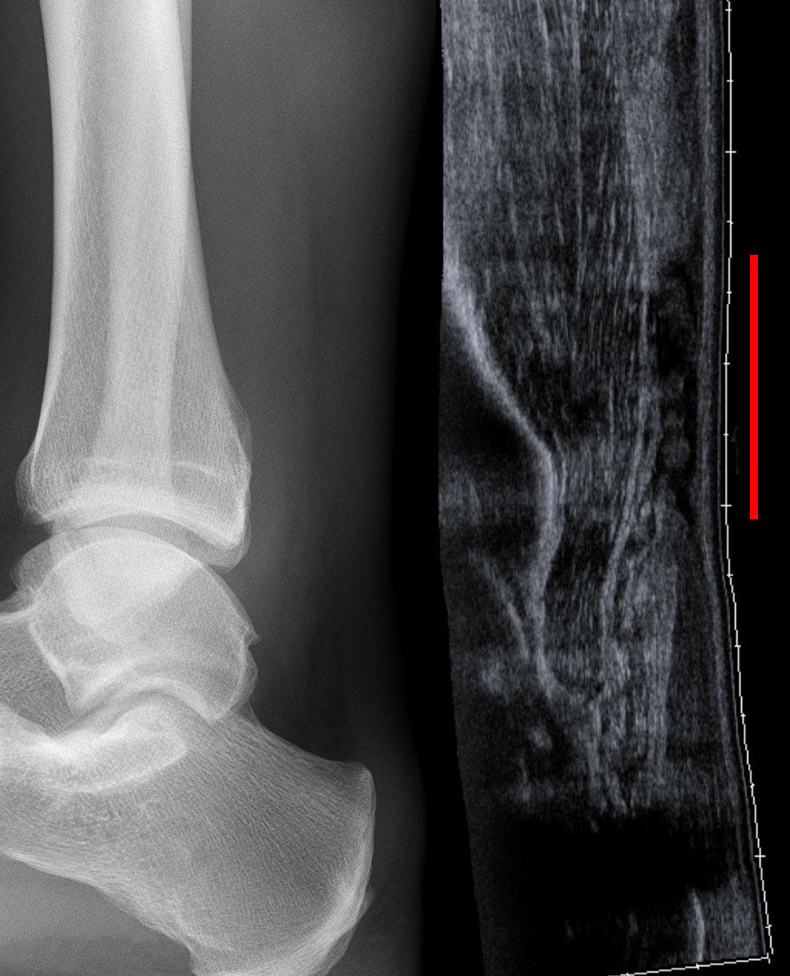 Two-panel image: a normal ankle X-ray and an ultrasound showing the gap of a torn Achilles tendon