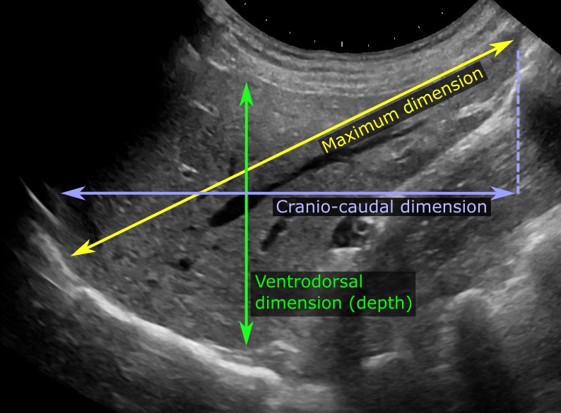 Ultrasound of the liver with its dimensions marked by measurement arrows