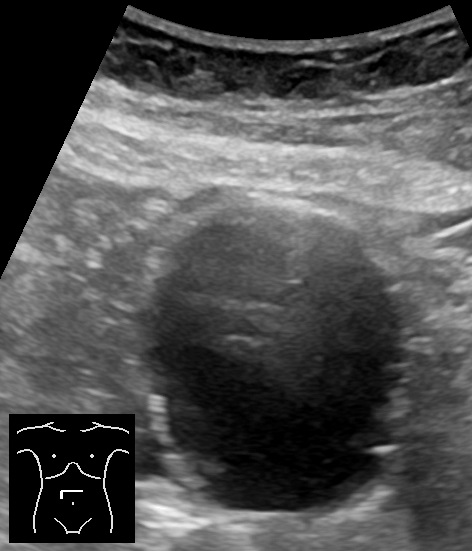 Ultrasound cross-section of an abdominal aortic aneurysm