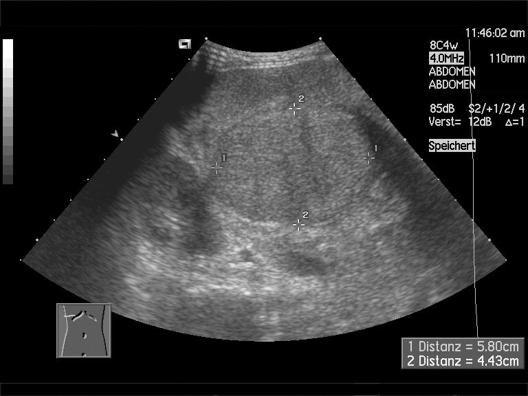 Ultrasound of a cirrhotic liver with a coarse heterogeneous texture