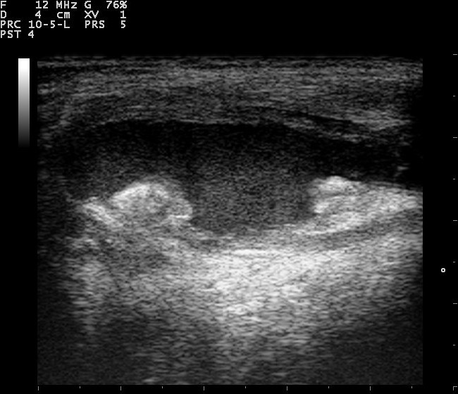 Knee joint effusion on ultrasound, anechoic fluid above the femoral condyles