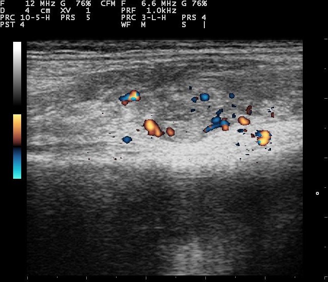Color Doppler of an inflamed knee showing blood flow in a thickened synovial lining