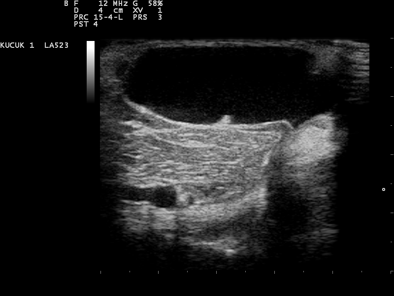 Baker's cyst on ultrasound, an anechoic popliteal fluid collection behind the knee