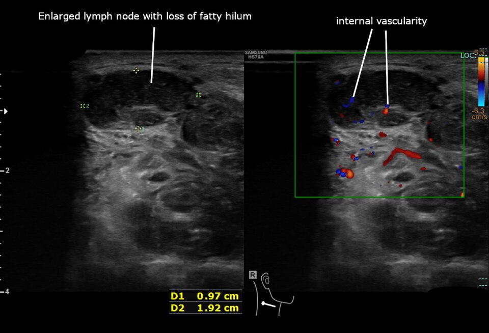 Ultrasound of an enlarged neck lymph node with loss of the fatty hilum and internal vascularity