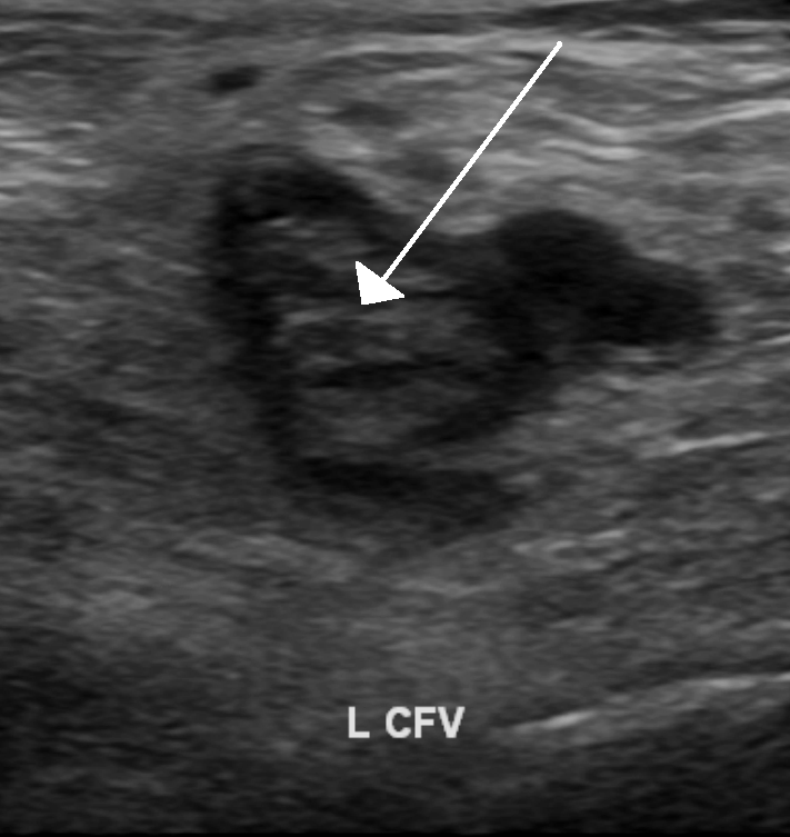 Blood vessel in short axis on ultrasound as a round dark cross-section