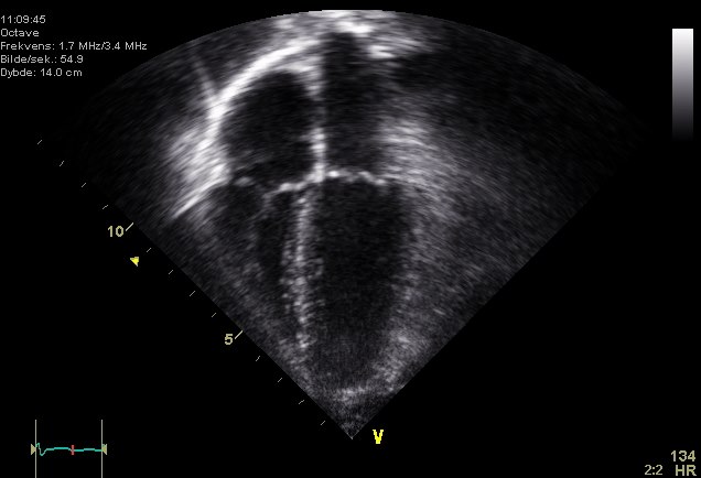 A real apical four-chamber echocardiogram showing the two ventricles and two atria in a fan-shaped ultrasound image.