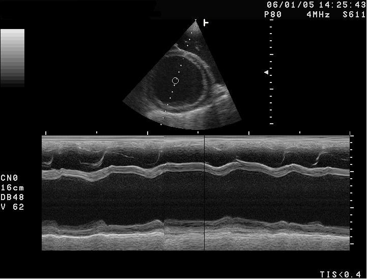 An M-mode echocardiogram of a dilated cardiomyopathy heart, the chamber walls tracing nearly flat lines with little movement.