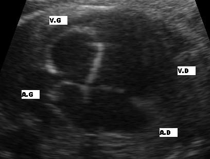 A short-axis echocardiogram at the level of the aortic valve, the valve cusps visible at the centre.