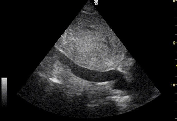 A subcostal ultrasound showing the inferior vena cava as a dark tube running beneath the liver toward the heart.