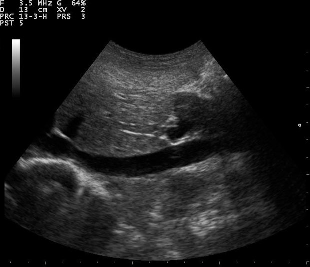 A second subcostal ultrasound of the inferior vena cava beneath the liver, the vessel visible as a dark stripe.