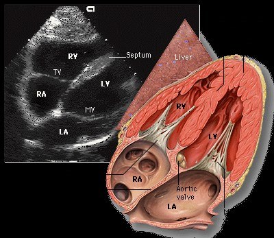 A subcostal four-chamber echocardiogram with the right and left ventricles labelled, beside an anatomical drawing.