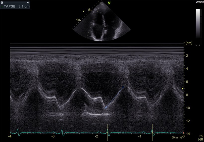 A TAPSE M-mode echocardiogram with the tricuspid annulus motion traced, reading 3.1 centimeters.