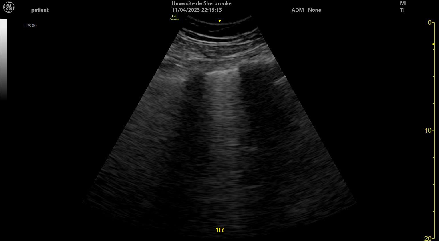 Lung ultrasound showing bright vertical B-lines fanning down from the pleura