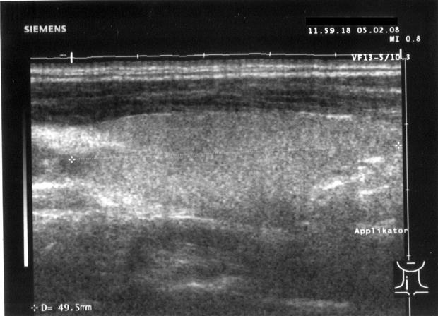 A longitudinal high-frequency ultrasound of the thyroid gland, the gland tissue shown in fine greyscale detail.